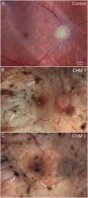 Glial remodeling and choroidal vascular pathology in eyes from two donors with Choroideremia